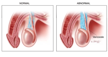 Grade 3 Varikosel Belirtileri ve Tedavisi Grade 3 Varikosel Belirtileri ve Tedavisi