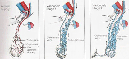 Grade 1 Varikosel