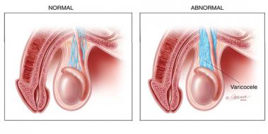 Grade 3 Varikosel