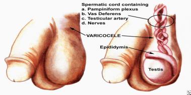 Varikosel Nasl Anlalr