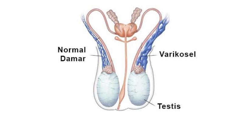 Varikosel Ameliyat Sonras