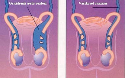 Varikosel Nedir